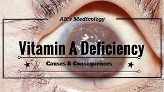 Vitamin A deficiency Causes amp Consequences  Dr Akshay Kewlani [upl. by Essilrahc717]