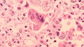 Measles could be easier to get than COVID19 UCSF doctor says Heres his warning as cases rise [upl. by Lihp689]