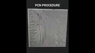 Percutaneous Nephrostomy PCN Procedure nephrology cathlab health study [upl. by Amy]