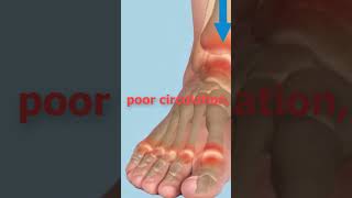 The shocking cause of ankle swelling  causes of edema  swollen feet  edema swollen ankles [upl. by Arriaes]