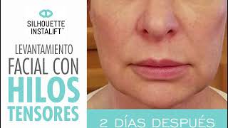 Levantamiento facial con hilos tensores [upl. by Lu]