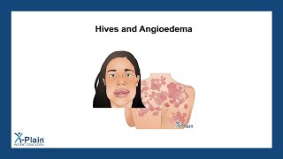 Hives and Angioedema [upl. by Esirahc]