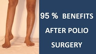 95  BENEFITS AFTER POLIO TREATMENT [upl. by Neggem]