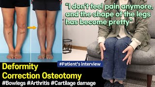 😊 Transformative journey from bowlegs to straight legs｜Patient interview [upl. by Oidivo]