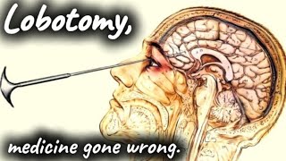 The DARK history of Lobotomy  medicine gone WRONG [upl. by Ahsilrac]