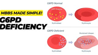 G6PD Deficiency in Hindi l Clinical Biochemistry Medicine l 1st yr MBBS [upl. by Bowrah27]