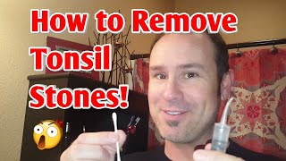 How to Easily Remove Tonsil Stones 💎💉 [upl. by Silverman]