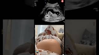 Ultrasound scan In Pregnancy baby fetusdevelopment cutebaby [upl. by Suzanna]