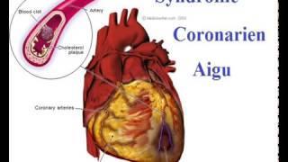 Syndrome coronarien Conduite à Tenir devant une crise cardiaque [upl. by Mirabella303]