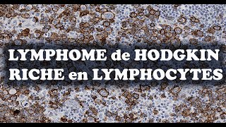 LE LYMPHOME DE HODGKIN CLASSIQUE RICHE EN LYMPHOCYTES IHC – PATHOLOGIE [upl. by Nytsirk374]