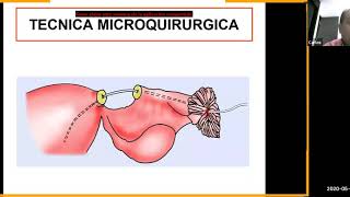 Recanalización tubarica por laparoscopia  MAY 21 [upl. by Kincaid671]