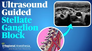 Ultrasound guided stellate ganglion block [upl. by Eibba]