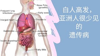 北美儿科Cystic Fibrosis囊胞性纤维症简介 [upl. by Hanan]