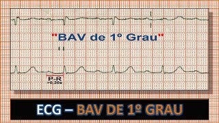 ECG  Eletrocardiograma com BAV de 1º Grau [upl. by Allsopp]