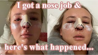 WHAT IT’S REALLY LIKE DAYS 17  MY SEPTOPLASTY amp RHINOPLASTY JOURNEY  Pt 1 [upl. by Jacqueline521]