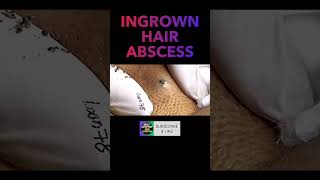 Ingrown Hair Infection Abscess With Pus [upl. by Yelbmik475]