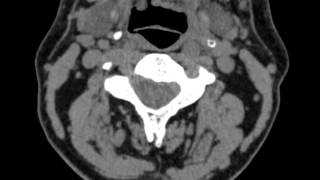 Hyoid bone  nonunion of left greater cornu [upl. by Dustan]