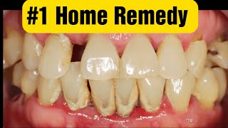 1 Home Remedy to Remove Dental Plaque and How to Prevent Tartar [upl. by Oreste]