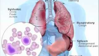 Mono Symptoms  What is Mononucleosis [upl. by Inilam]