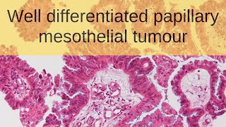 Well Differentiated Papillary Mesothelial Tumour of Tunica Vaginalis  Pathology mini tutorial [upl. by Byrdie]