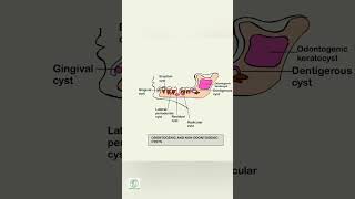 ODONTOGENIC AND NON ODONTOGENIC CYSTdental dentalschool mouth [upl. by Craggie]