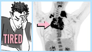 LYMPHOMA After Ignoring 6 WARNING Signs [upl. by Mary]