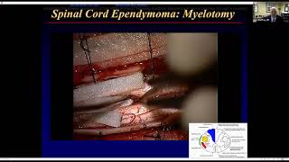 Nuances in the Care of Spinal Cord Ependymoma  Mark E Shaffrey MD [upl. by Aaren]