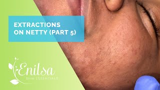 Blackhead Extractions on Netty  Fifth Treatment [upl. by Aamsa709]