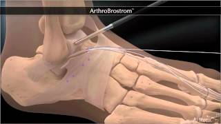 Bandrekonstruktion bei chronischer Instabilität des Sprunggelenkes  Arthroscopic Broström [upl. by Matt41]