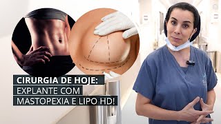 EXPLANTE COM MASTOPEXIA E LIPO HD COM DEFINIÇÃO LEVE [upl. by Nnav]