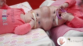 Conjoined Twins Delaney Sisters Did They Survive the Worlds Riskiest Separation  Body Bizarre [upl. by Johnson]