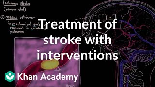 Treatment of stroke with interventions  Circulatory System and Disease  NCLEXRN  Khan Academy [upl. by Adnilema340]