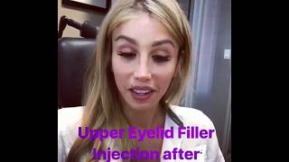 Upper Eyelid Filler Injection After Facial Feminization Surgery [upl. by Cotterell95]