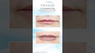 Why Hyaluronic Acid Fillers are Safer than PermanentSemiPermanent Fillers lipfiller [upl. by Pratt]