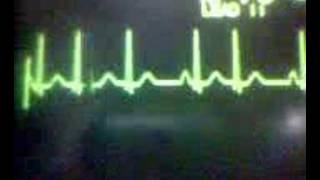 ECG Video Ectopics  Junctional [upl. by Arod]