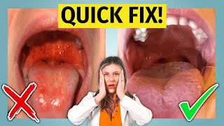 Strep Throat  treat it fast learn how [upl. by Icyak]