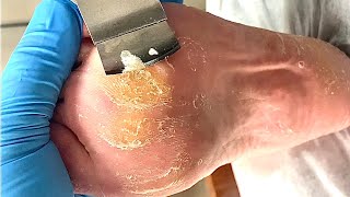 Callus removal from feetampFoot scraping dead skin【Xiao Yan pedicure】stress 17 [upl. by Asenev]