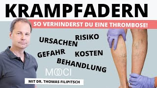 KRAMPFADERN  Ursachen Gefahr Behandlung Risiken Kosten [upl. by Aramas]