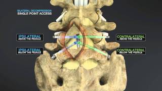 Medical Animation of Lumbar Stenosis Decompression [upl. by Eycats885]