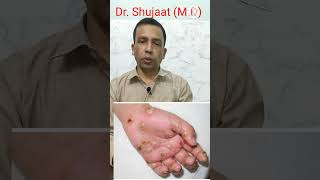 Scabies Causes Symptoms and Treatment Khujli ka ilaj [upl. by Htebizile]