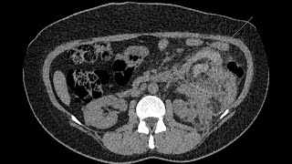 Hemorrhagic renal angiomyolipoma in a tuberous sclerosis phakomatosis patient [upl. by Bugbee279]