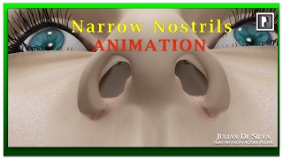 Rhinoplasty Animation  How can Wide Nostrils be Narrowed [upl. by Kalagher]