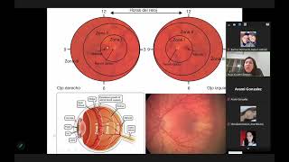 Retinopatía del prematuro y retinopatía diabética Parte 1 [upl. by Ilonka179]