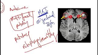 Video 217 Overview of Demyelinating Disorders Clinical Features Diagnostics and Risk Factors [upl. by Hedva]