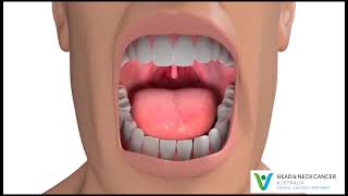 Oral Cancer  What Is It What are the Symptoms and Treatment  Head and Neck Cancer [upl. by Eadnus]