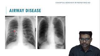 CHEST X RAY IN AIRWAY DISEASE COPD [upl. by Wolram]