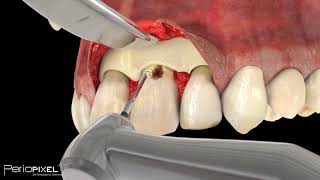 Avance vídeo completo quotCaries Subgingivalquot  PerioPixel [upl. by Sprung]