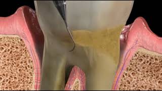 Laser Assisted Periodontal Therapy [upl. by Sert]