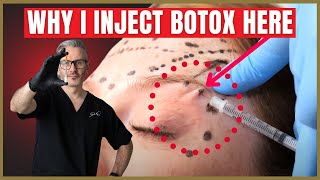 How To Inject Botox Under The Brow  Botox Brow Lift Advice [upl. by Arlene265]