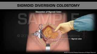 Sigmoid Diversion Colostomy [upl. by Stempien]